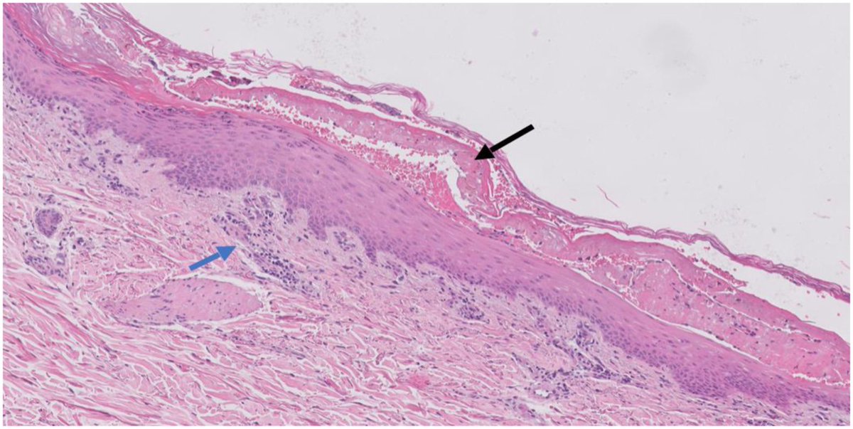Check our last paper published in <a href="/JACIInPractice/">JACI In Practice</a>, Nivolumab-induced Stevens-Jonhson syndrome:
🎯PD-1 inhibition?
🤧Type IV hipersensitivity reaction?
🌪️ The perfect storm 🌩️
<a href="/jesusentralgo/">Jesús Chamorro</a> <a href="/nataliarot/">Natalia Rodríguez Otero</a> <a href="/DrEmilioSolano/">Emilio Solano Solares</a>