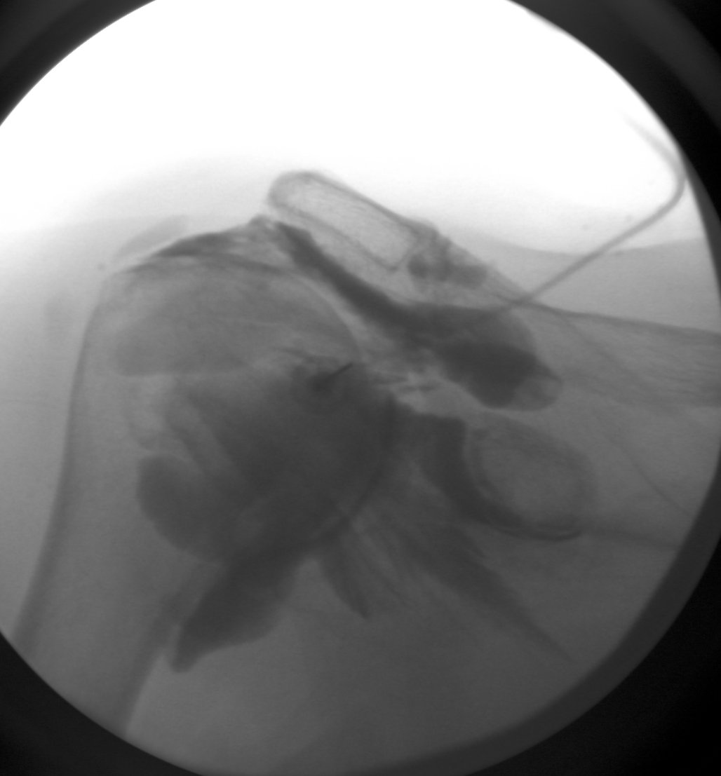 #CaseOfTheWeek ‼️🥳‼️

☢️🩻☠️Case#26☠️🩻☢️ provided again by @JW_Stephenson‼️

*2 answers*❕❗❕
➡️➡️📲#Diagnosis❔ #Sign❓🦴👀🧩

#FOAMrad #RadEd #OrthoTwitter @ssr_rwg @UWRadRes #OrthoSports @AOSSM_SportsMed