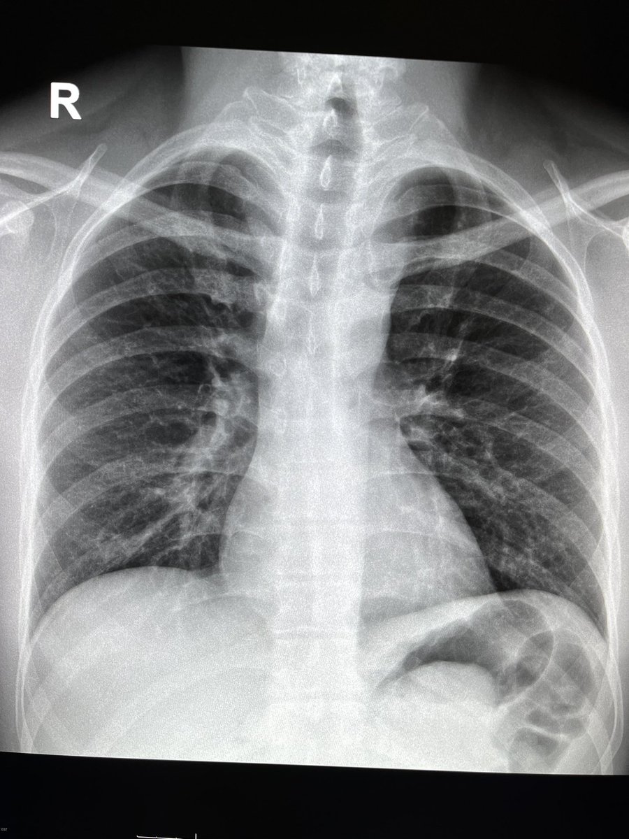 Spot the eagle eye👇🏻👇🏻

@DrRSheth11 @DrYevSam_Rad @drdevrad 
@FOAMrad