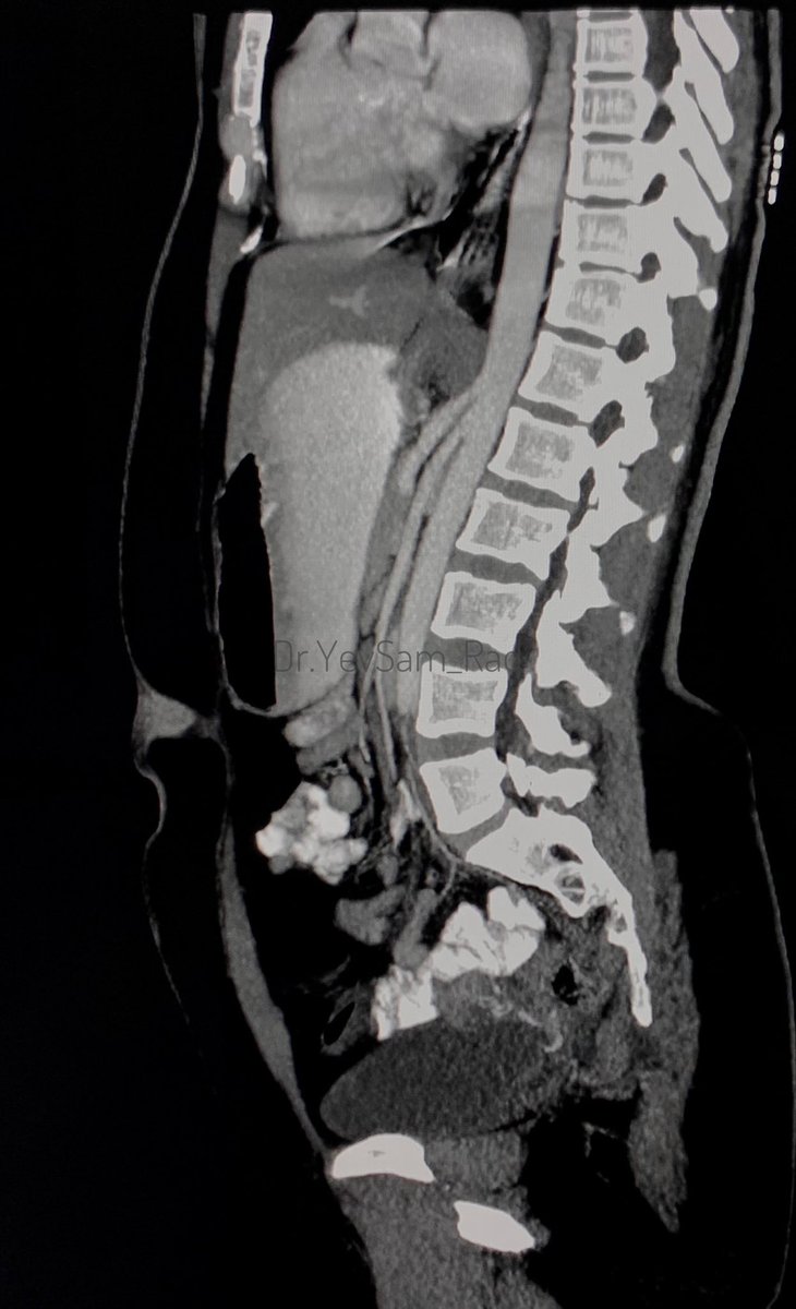 Young female, recurrent Pain abdomen.
#Radtwitter 
#FOAMed 
#RadRes 
#Foamrad 
#Medtwitter
#crosssectionalimaging