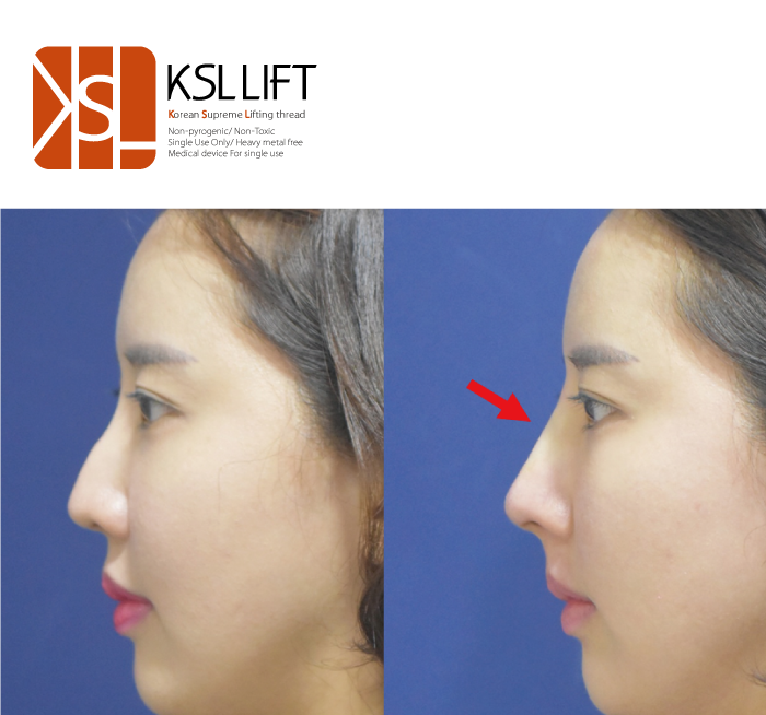 JeongSo44394036's tweet image. Nose-Thread
#ksl #ksllift #liftingthreads #threadslifting #supreme #supremelift #placl #pdo #pdothreads #pcl #pclthreads #moldingthread #monothreads #screwthread #cogthread
#nosethreadlift #duallifting #dualneedlecog #cannula #360degree #coglift #necklifting