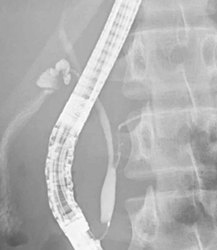 General_medic's tweet photo. 18 歳の男性。心窩部不快感と嘔吐を主訴に前医受診し、血液検査にて血清 AMY 値 3,534 U/L、造影 CT 検査にて膵周囲脂肪織濃度上昇を認め、軽症急性膵炎と診断され、保存的加療さ���た。膵炎軽快後、若年発症の膵炎の原因精査目的に当院紹介となった。幼少時から年に数回腹痛がある。
入院時現症：身長 179cm、体重 53kg。意識清明、黄疸なし。腹部平坦軟、心窩部に圧痛なし、腫瘤触知なし。
血液所見：赤血球368万、Hb 11.1g/dL、Ht 33％、白血球5,700、血小板21万。血液生化学所見：総ビリルビン 0.8 mg/dL、AST 24 U/L、ALT 32 U/L、ALP 246 U/L（基準115～359）、γ-GTP 44 U/L（基準8～50）、アミラーゼ 155 U/L（基準37～160）、IgG4 87 mg/dL（基準4.8〜105）。免疫学所見：CEA 2.3 ng/mL（基準5以下）、CA19-9 7 U/mL（基準37以下）。内視鏡的逆行性胆管膵管造影写真〈ERCP��を別に示す。

この疾患における以下の記述で正しいのはどれか。1つ選べ。
a. 男性に多い
b. この患者は先天性胆道拡張症を伴っている。
c. 胆管と膵管が十二指腸固有筋層内で合流する。
d. 胆汁中アミラーゼ値上昇を認める。
e. 高頻度に膵癌を合併する
https://t.co/z1ByGdz10W