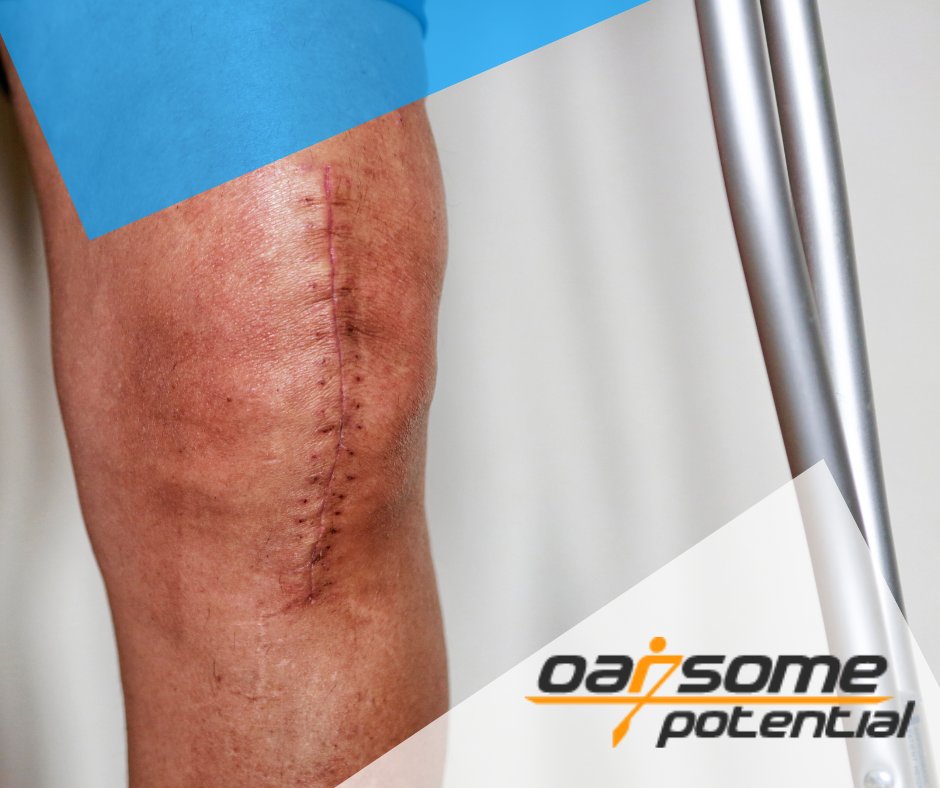 Improve your overall crutch experience with #OarsomeGrips! Not only do our grips provide exceptional comfort for your hands and arms, but they also help reduce strain, making your entire experience on crutches more enjoyable!