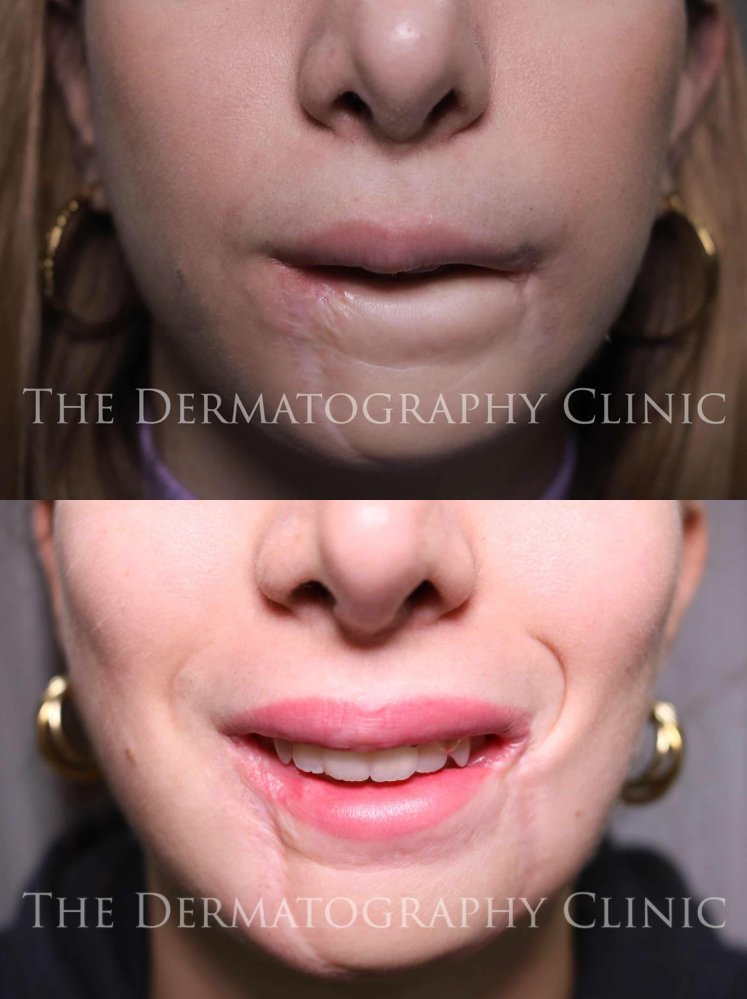 By covering scar tissue with a cosmetic tattoo, it allows individuals to reclaim their self-confidence and embrace their bodies without self-consciousness, in some cases blurring the memory of past trauma. Read more about Adele's story...

bit.ly/43XqgQx