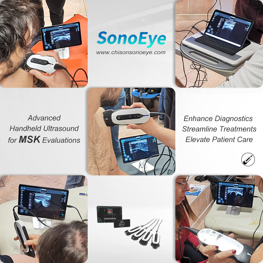 A perfect synergy of portability and image quality with #SonoEye in #MSK evaluation. Its high-resolution imaging capability allows for precise visualization of musculoskeletal structures, empowering #healthcare professionals to assess with confidence anytime, anywhere. 
#HHU
