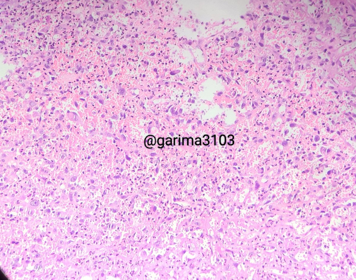 Garima3103's tweet photo. 46/M with multifocal oral lesions - b/l palate and lower alveolus
Below are the histopathology images 
Pour in your views and opinions! 
#pathology #PathTwitter #headandneckpath @AnupamaArya12 @padmapathology1 @pepeheffernan @kriyer68 @aanchalkakkar https://t.co/sKdHXN3dhf