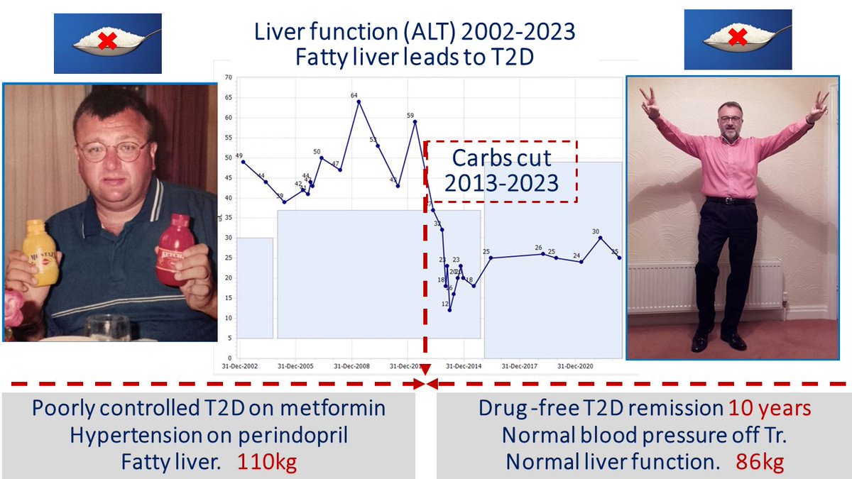 lowcarbGP's tweet photo. TEN YEARS of drug-free T2D remission for this amazing patient!! We first wrote him up in the @bmj_latest in 2015. Look how liver function mirrors his progress after going lowcarb.Fatty liver is part of T2D Find out how we have done this for 129 people here https://t.co/MoDK29wd9B https://t.co/7lAU0pL7IG