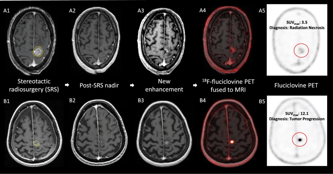 A prospective study by @MartinTomMD and colleagues showed that PET/CT with 18F-fluciclovine, a repurposed widely available radiotracer, has promising ability to distinguish radiation necrosis from tumor progression after #radiosurgery. Read more: link.springer.com/article/10.100…