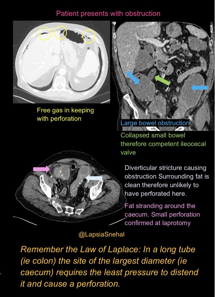 Bit of a physics and radiology combo for this case …#FOAMrad #FOAMed #meded  #radres #colorectal #futureradres #medstudenttwitter #gitwitter #anatomy #frcr #surgery #radiology #radtwitter #medtwitter