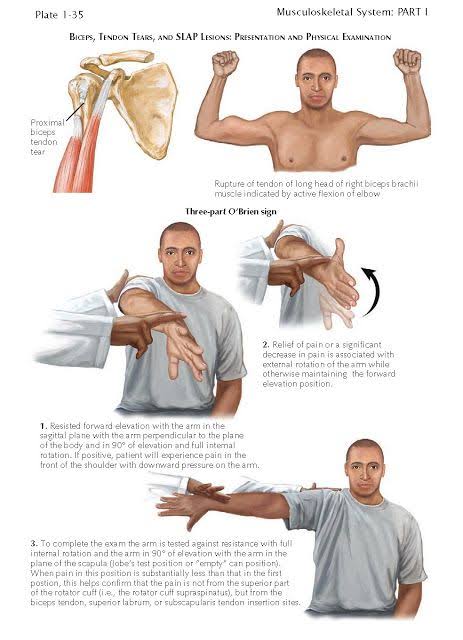 <a href="/BrownJHM/">Journal of Brown Hospital Medicine</a> Popeye sign.