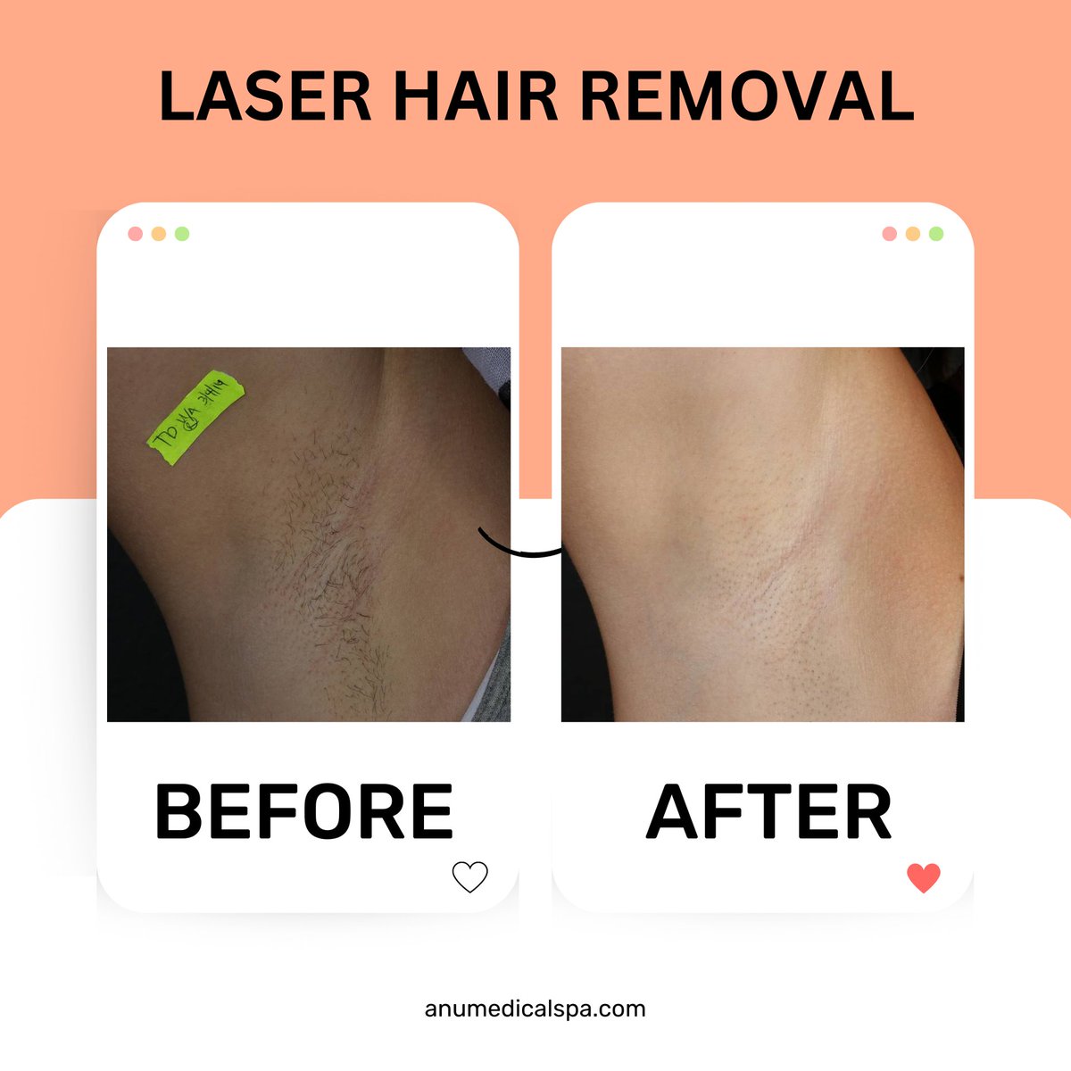 AnuMedSpa's tweet photo. Laser Hair Removal Clients! We are at the start of this Summer Season, be sure to wear sunscreen and be mindful of sun exposure. 

Visit the link in or bio or call: (856)-809-0909 to learn more! https://t.co/qowH1C0cNY