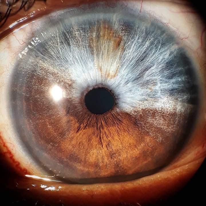 Spot Diagnosis.🎨
Concerned with Melanin distribution. What congenital syndromes can be associated with this condition?
#MedTwitter #Medical #MedEd #Clinical #eyes #Ophthalmology #eyetwitter