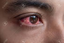 HOW TO KNOW IF YOUR TEEN IS VAPING (4)
Bloodshot Eyes - There aren’t many physical signs that a teen is vaping. However, bloodshot eyes can be a clue. 
#safety #healthylifestyle #who #health #healthandsafety