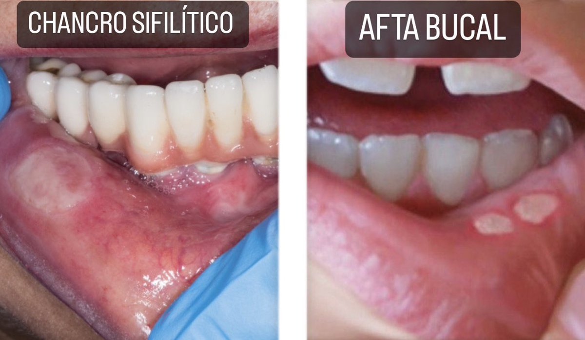 EstebanKle's tweet photo. ⚠️ DIFERENCIA ENTRE CHANCRO SIFILÍTICO Y AFTA BUCAL⚠️
📍 Chancro: Indoloro, generalmente aparece una lesión con bordes elevados, centro ulcerado y es una lesión primaria de Sífilis.
📍Afta: Arden mucho, lesión plana, aparecen muchas (generalmente), múltiples causas (NO ITS). https://t.co/FktA9DyXIJ