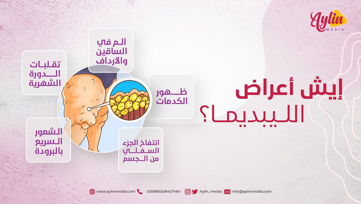 أعراض مرض #الليبيديما ما هي بس انتفاخ وتورم في الفخذين والساقين، وهذا جزء من الأعراض
#أيلين_ميديا #وذمة_شحمية