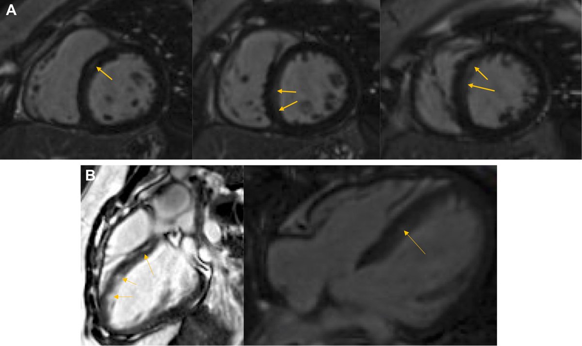 #JACCCaseReports Clinical Quiz: A 19 y/o woman ➡️ sudden cardiac arrest 5 weeks after premature delivery ➡️ #ECG QTc: 534 ms ➡️ #whyCMR: consistent with dilated cardiomyopathy.

Read more and vote below! #CardioTwitter #EPeeps #DCM @NHosadurg