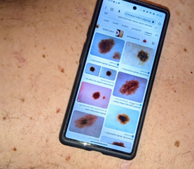 What French Melanoma patients know about AI use in their disease: a melanoma patient advocate observation in online forums
itobos.eu/index.php/diss…
#ArtificalIntelligence #melanoma #PatientCare #advocate