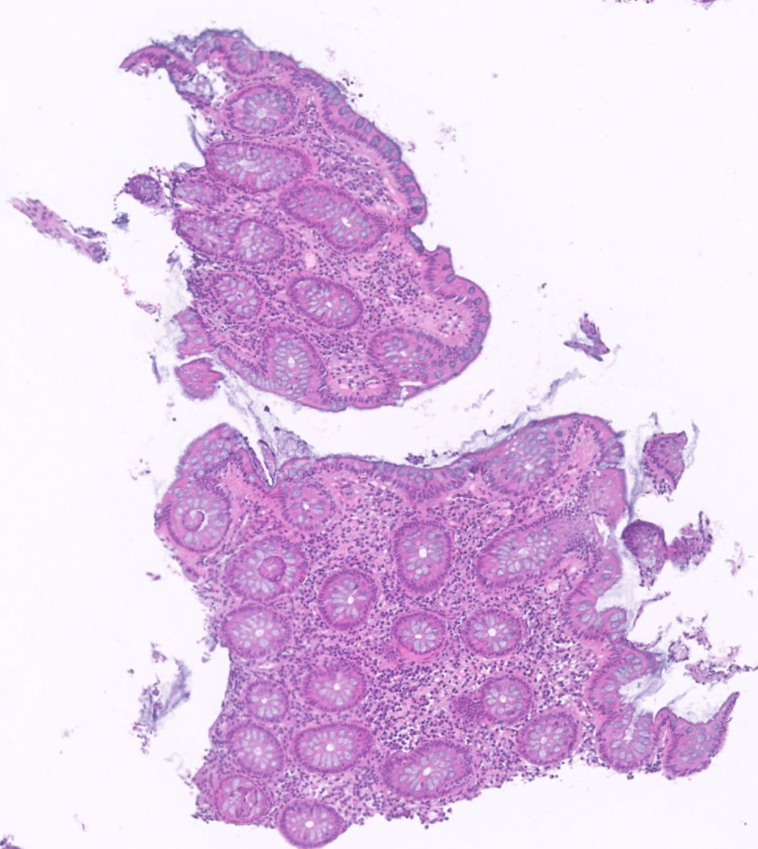 RyCPatologia's tweet photo. ➡️ Biopsia de colon en paciente VIH.
🔬 Técnica: Warthin-Starry.
☑️ Espiroquetosis intestinal.
#GIpath #rycpath https://t.co/N3aQs1QF1i