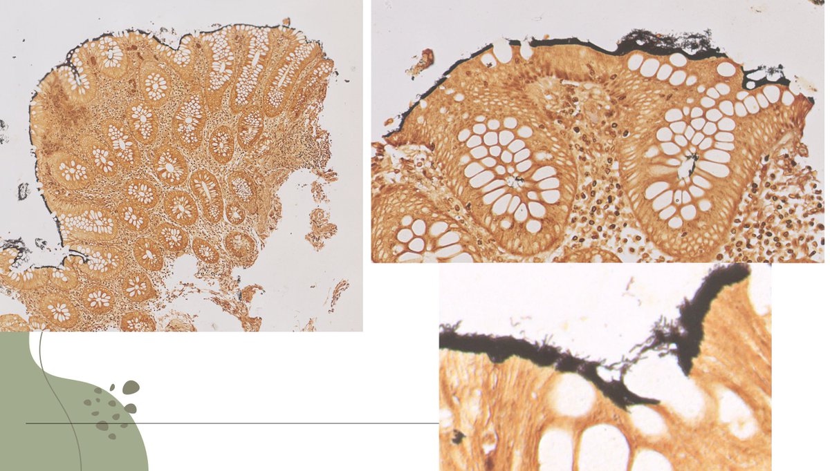 RyCPatologia's tweet photo. ➡️ Biopsia de colon en paciente VIH.
🔬 Técnica: Warthin-Starry.
☑️ Espiroquetosis intestinal.
#GIpath #rycpath https://t.co/N3aQs1QF1i