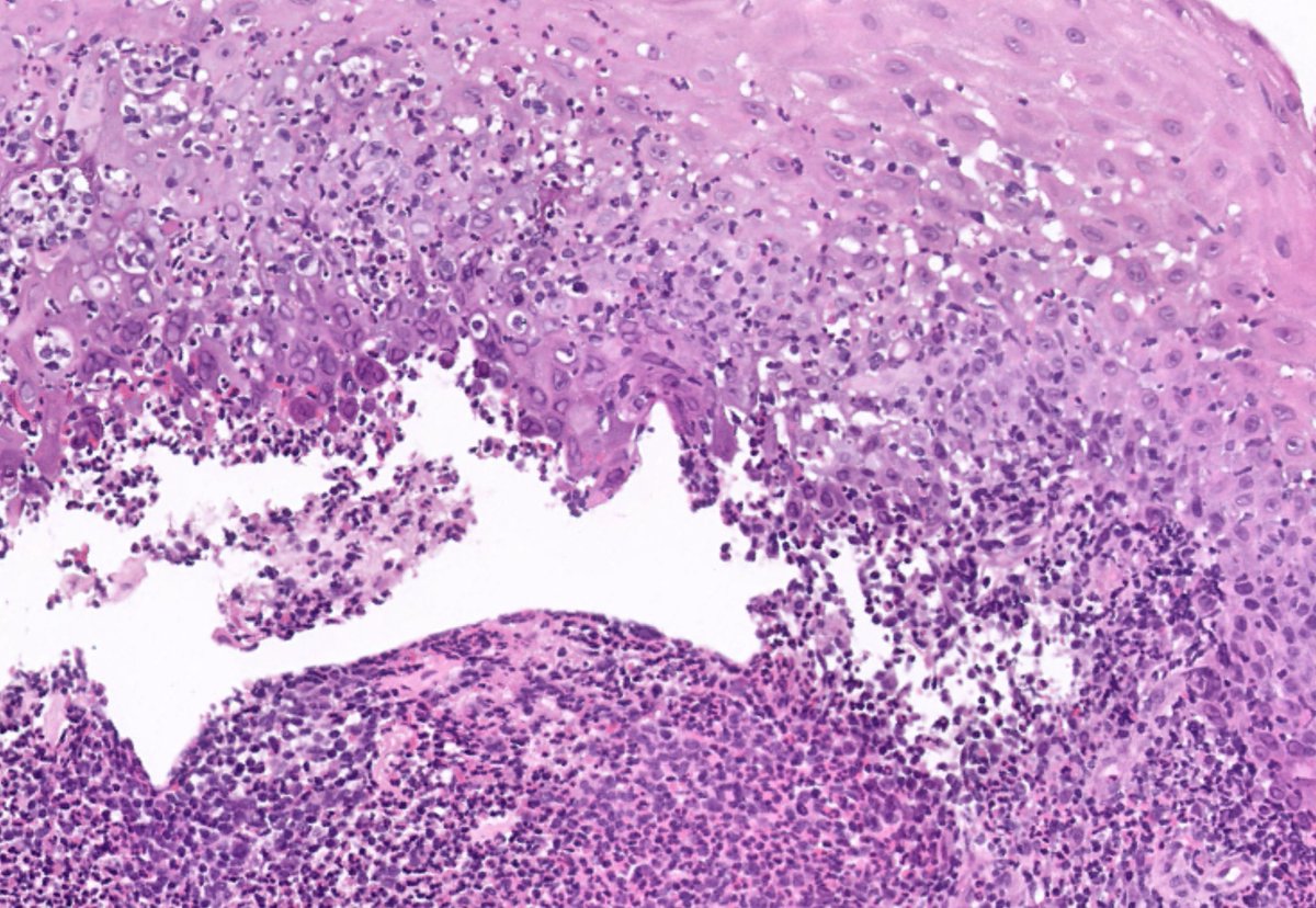RyCPatologia's tweet photo. ➡️ Esofagitis péptica, grado 3.
🔬 Inmunohistoquímica: HHV.
☑️ Esofagitis herpética.
#GIpath #RyCPath https://t.co/oRYomMEa01