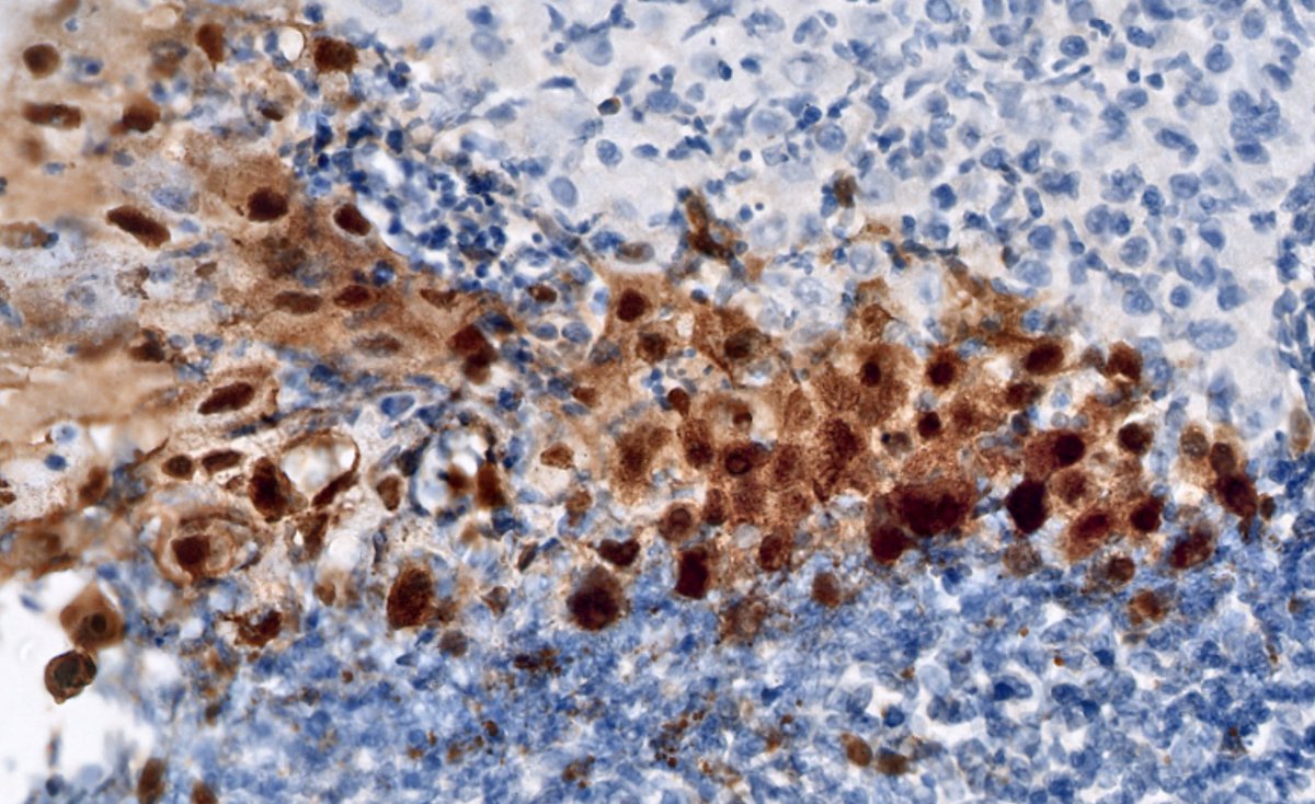 RyCPatologia's tweet photo. ➡️ Esofagitis péptica, grado 3.
🔬 Inmunohistoquímica: HHV.
☑️ Esofagitis herpética.
#GIpath #RyCPath https://t.co/oRYomMEa01