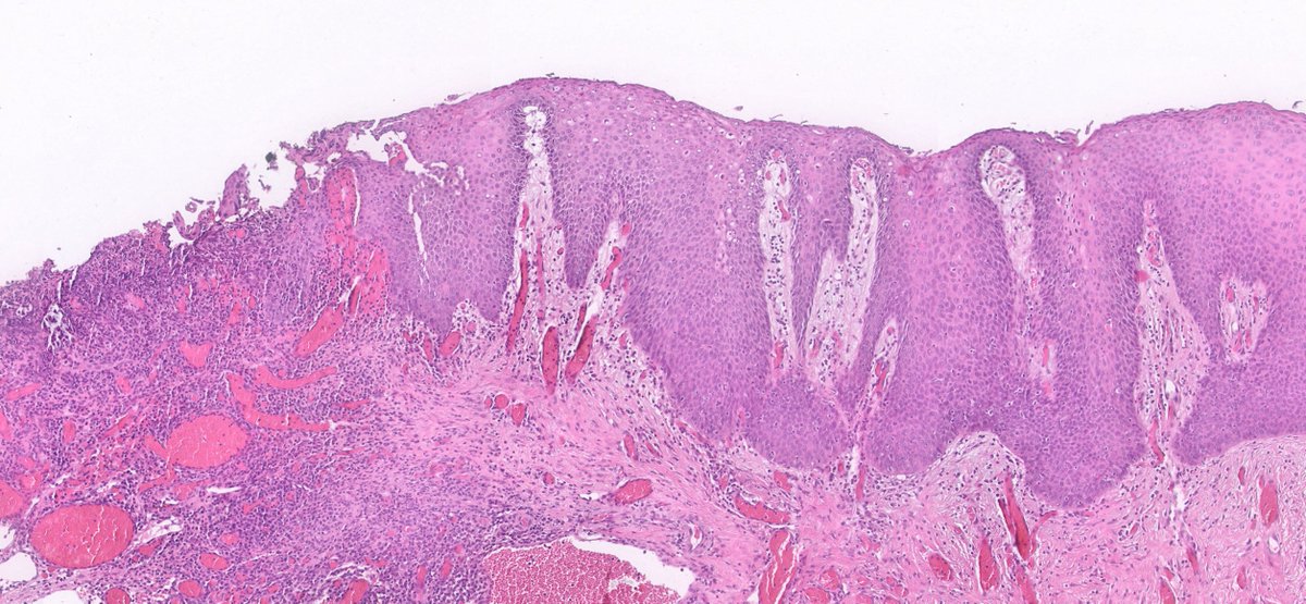 RyCPatologia's tweet photo. ➡️ Úlcera anal.
🔬 Inmunohistoquímica: HHV.
☑️ HSIL y HHV concomitantes.
#GIpath #RyCpath https://t.co/8b7koYXlM1