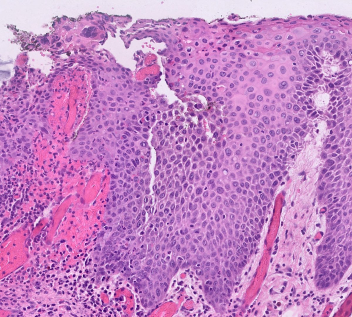 RyCPatologia's tweet photo. ➡️ Úlcera anal.
🔬 Inmunohistoquímica: HHV.
☑️ HSIL y HHV concomitantes.
#GIpath #RyCpath https://t.co/8b7koYXlM1