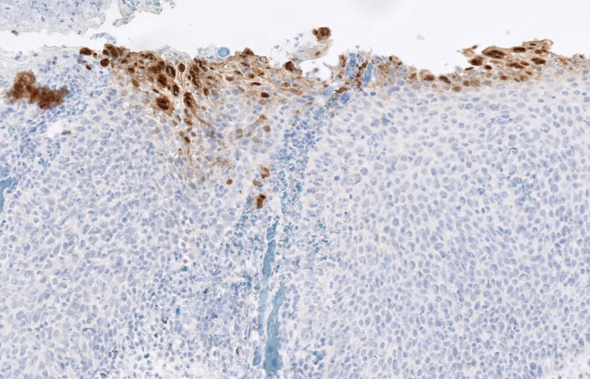 RyCPatologia's tweet photo. ➡️ Úlcera anal.
🔬 Inmunohistoquímica: HHV.
☑️ HSIL y HHV concomitantes.
#GIpath #RyCpath https://t.co/8b7koYXlM1