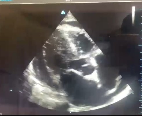 IMInsightsMK's tweet photo. Bedside Cardiac ECHO showed this

@JosephRuberwa 
@dr_bongomin 
@IAmTheOlum 
@HilderKoriang 
@RoseMuhindo1 
@drkeithsiau 
@emmyrov 
@HeartUganda 
@Ug_kidneyf https://t.co/RJYXgzeO0w