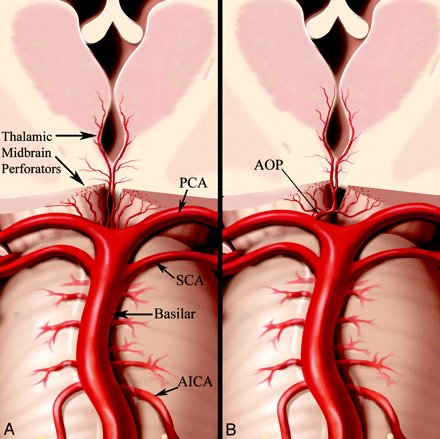 3/n
Answer: Artery of Percheron (AOP) ✅ causing Bilateral Thalamic Infarction.

Pic A- conventional anatomy shows paired thalamic & midbrain perforating arteries

Pic B- AOP arising as a single unpaired trunk from P1, supplying bilateral paramedian thalami & rostral midbrain