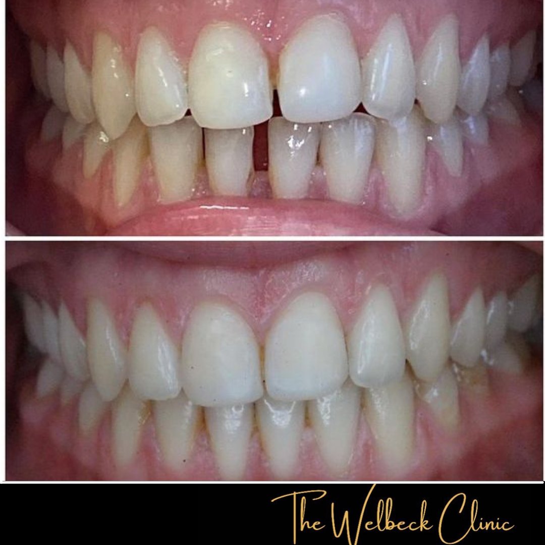 An Invisalign case completed by Dr jahany, just 6 months of Invisalign to create this lovely aligned smile. 
To book a consultation, contact us on 0207 486 8100
#invisalign #smile #6monthssmile #london #dentistry #cosmeticdentisry #align #happypatient #dentist #teeth

JUST NOW