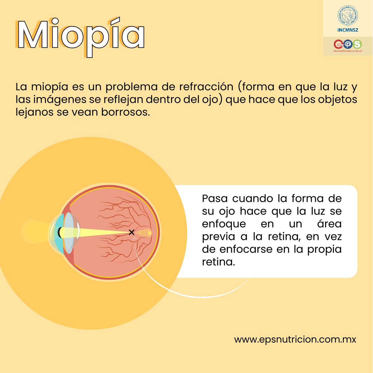 INCMNSZ_EPS's tweet image. #Miopía | Instituto Nacional de Ciencias Médicas y Nutrición Salvador Zubbirán

#Oftalmólogo #Visión #Ojos #Vista #VerDeLejos #ProblemasOculares #EnfermedadesOculares #Retina #ProblemaDeRefracción #VisiónBorrosa #FatigaOcular #EPS #INCMNSZ
