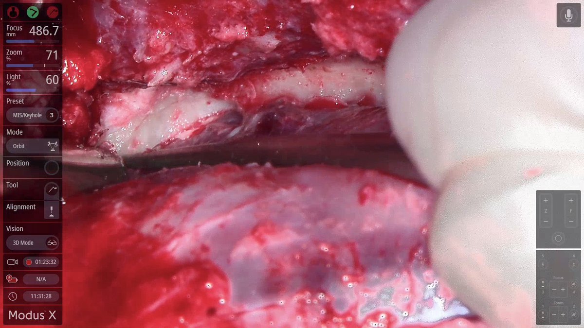 SynaptiveMed's tweet photo. Dr. Andrew Gogos from @StVincentsMelb leveraging the #SynaptiveMedical #roboticexoscope #ModusX to facilitate a left pterional craniotomy for resection of a hyperostosing spheno-orbital meningioma, including deroofing the optic nerve, an anterior clinoidectomy and cranioplasty. https://t.co/BeC70ijZYn
