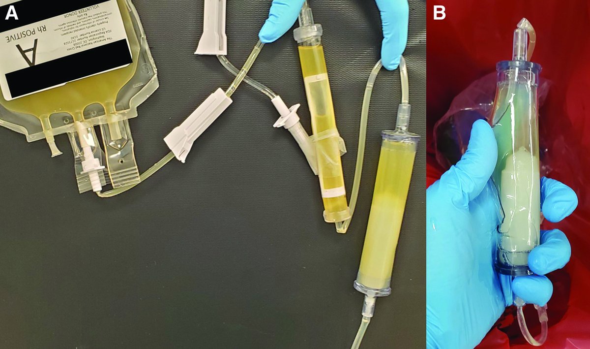 Images in #Anesthesiology - Coagulated Cryoprecipitate in an Intravenous Line 📷 ow.ly/FQGb50OYrPW