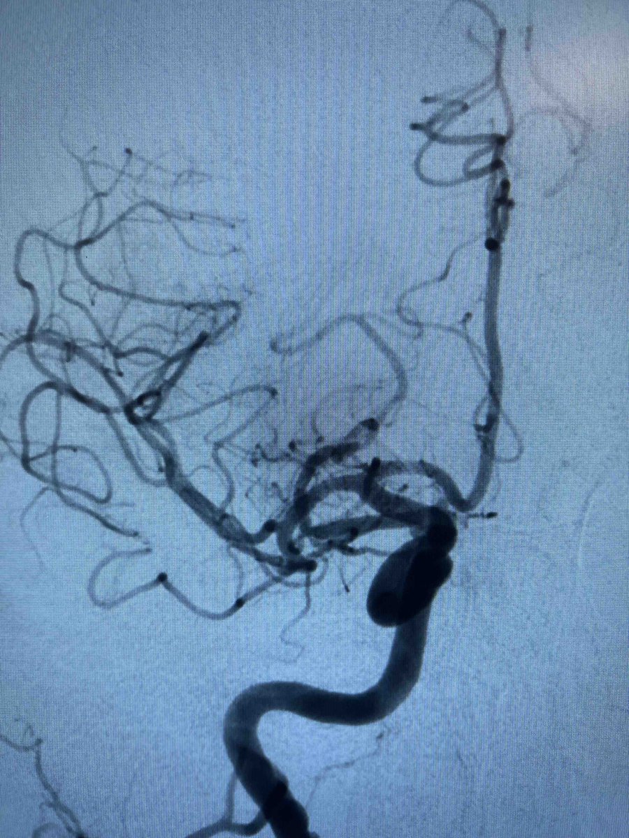 PenNeuro's tweet image. US HCPs: Great case out of Las Vegas, NV with Dr. Hardman, #RED62 with #RED43 for an MCA occlusion. Rx only. For risk info: bit.ly/2BYj7Yj Clinical results may vary.