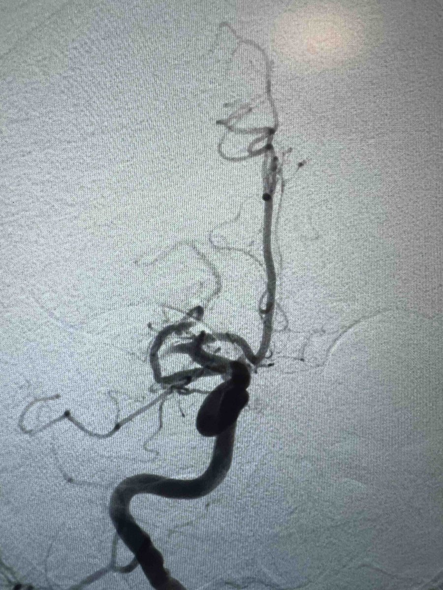 PenNeuro's tweet image. US HCPs: Great case out of Las Vegas, NV with Dr. Hardman, #RED62 with #RED43 for an MCA occlusion. Rx only. For risk info: bit.ly/2BYj7Yj Clinical results may vary.