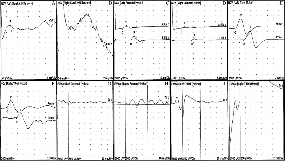 A 59 year old male developed sudden onset of a rare combo of Guillain-Barre Syndrome and Transverse Myelitis just 60 days after the COVD Vaccine Booster.

He developed lower back pain, numbness and tingling, and two weeks later was unable to walk and lost leg functionality. He…