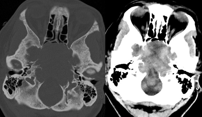 What is the most likely diagnosis? 🧠 

More images in 🧵 
#neurosurgery #ent #neurology #radres @ASHNRSociety #futureradres