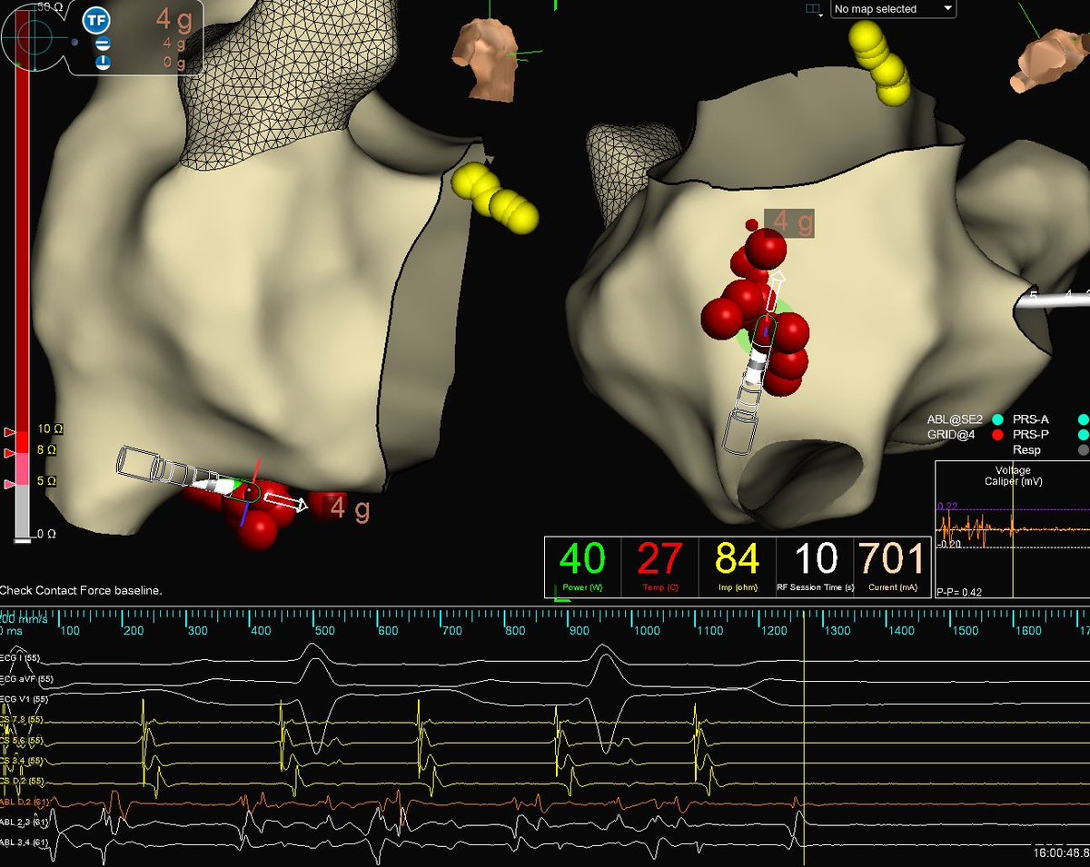 Superior signal quality on #TactiFlex during this CTI ablation with @DrDanHaithcock

Stability of the catheter and reduced flow allows for signal attenuation all the way to termination…game changer! 

@AbbottCardio