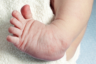 The Definition of Clubfoot dlvr.it/SrKRQy
