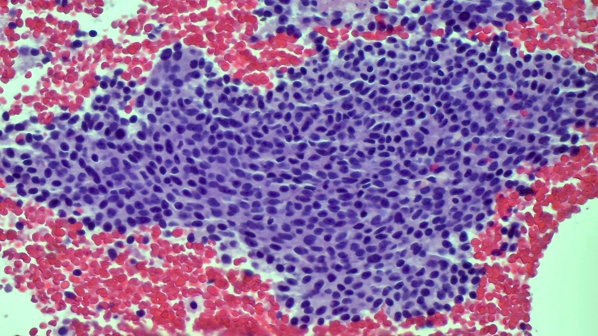 Andresangel3's tweet image. #FNApath #Cytopath 79 y/o woman. Suspicious adrenal mass. History of breast and Lung Ca.  EUS biopsy shows blood and some clusters of very bland cells. Opinion ?
