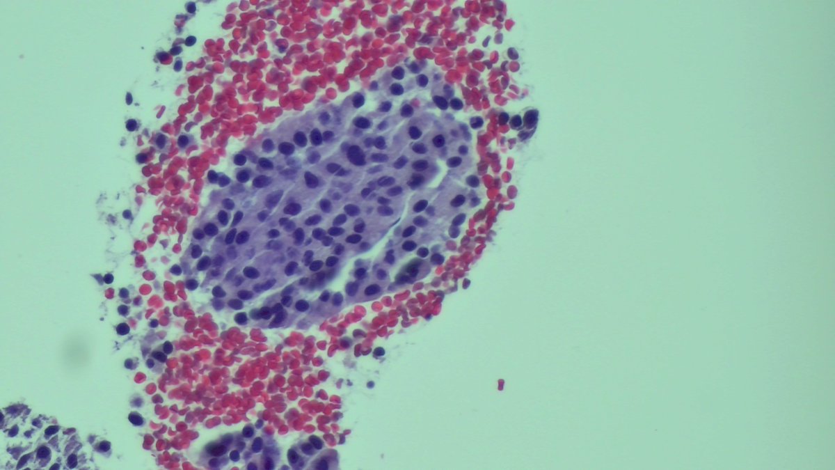 Andresangel3's tweet image. #FNApath #Cytopath 79 y/o woman. Suspicious adrenal mass. History of breast and Lung Ca.  EUS biopsy shows blood and some clusters of very bland cells. Opinion ?