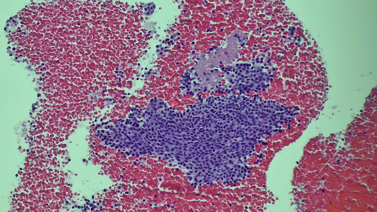 Andresangel3's tweet image. #FNApath #Cytopath 79 y/o woman. Suspicious adrenal mass. History of breast and Lung Ca.  EUS biopsy shows blood and some clusters of very bland cells. Opinion ?
