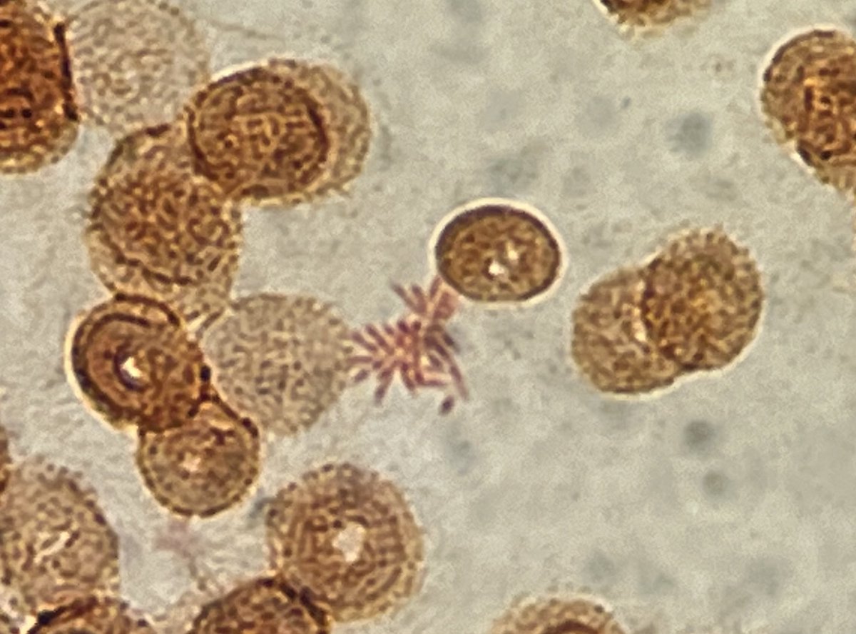 DrIDMIcro's tweet photo. This gram negative bacteria is a rare cause of endocarditis and has an unusual gram stain morphology. Here we see it aggregating into a rosette. https://t.co/dn2Exhjr3z