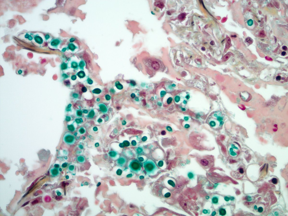 smlungpathguy's tweet photo. Disseminated cryptococcosis is another example where morphologic findings in lung predict disseminated (extrapulmonary) disease
Note yeasts within alveolar septal capillaries
#pathbugs #crittersontwitter #pathology #pulmpath https://t.co/af9uBEukG8