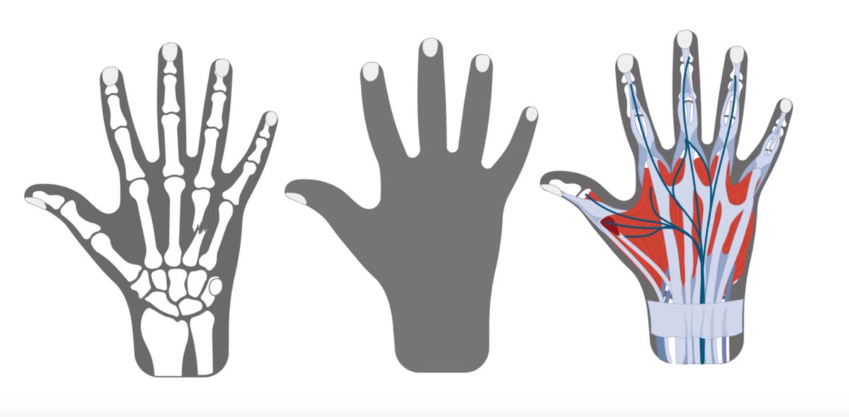 Evaluating Hand Injuries in the ED

🔗 tinyurl.com/4w9a638u

#FOAMed #Ortho #OrthoHand #FOAMortho #MedTwitter #EMBound 

@CUEmergency @DenverEMed