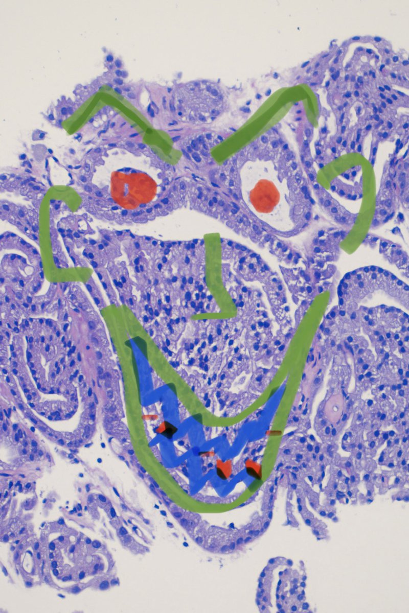 @evacomperat I don’t know but it looks scary to me… 😜

#gupath #prostatecancer