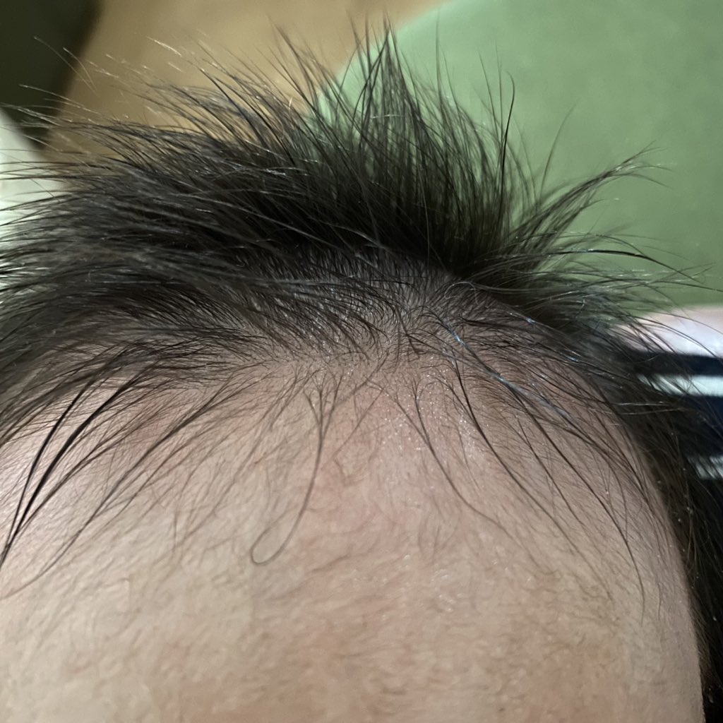 いざ！1ヶ月検診へ。前回の1週間検診で「体重増えすぎです。制限してください」と言われてしまうも増える量変わらず、また叱られそうだが『わし（180cm）の子じゃーーーい！大きく育ちそうですよね！』で乗り切るぞ💪 https://t.co/x4s9M7TmHy