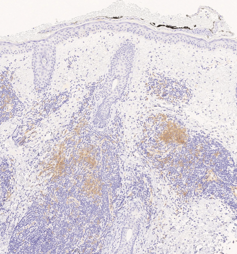 #toofartodiagnose? WSI at kikoxp.com/posts/27190 and contrast with the  WSI at kikoxp.com/posts/26597 #dermpath #dermatology #dermtwitter #PathTwitter #pathology @JMGardnerMD @kiko4docs @forthejon