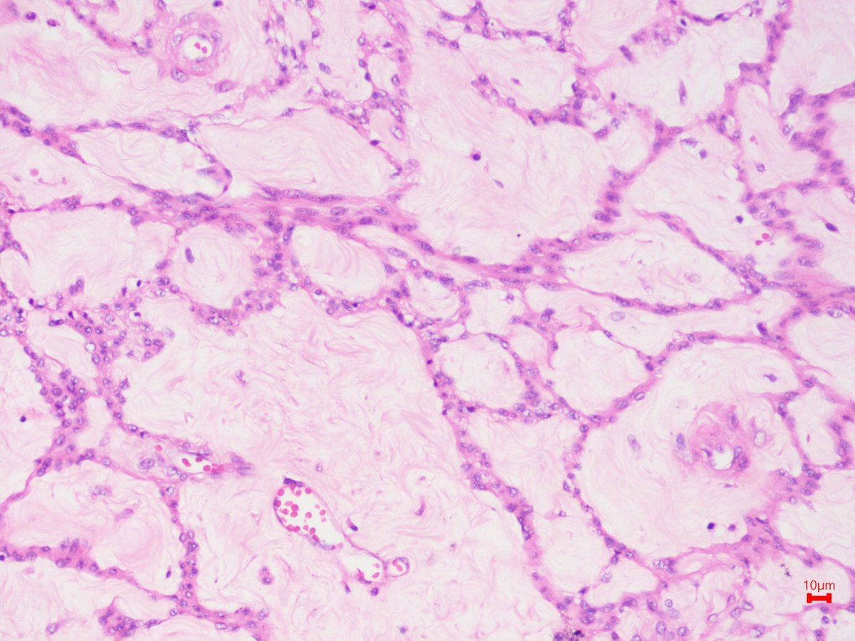 Can you classify this unique case of leiomyoma #pathology #pathogists #PathTwitter #Gynaepath